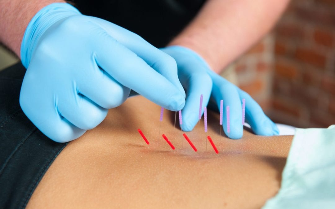 Sports Performance and Recovery: Why Athletes Use Chiropractic and Dry Needling